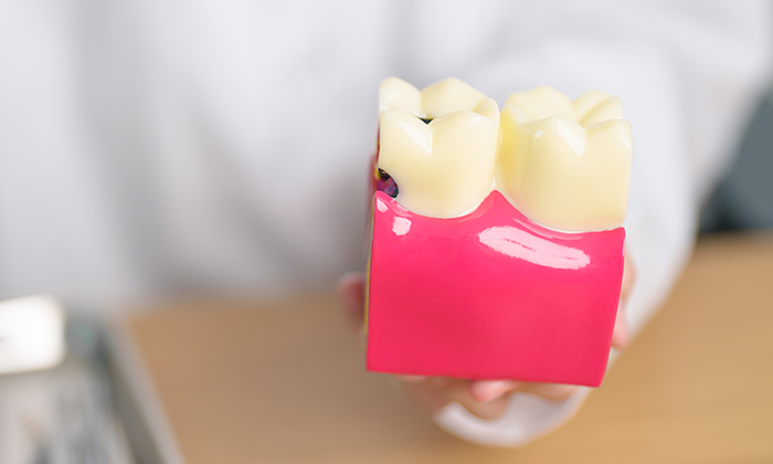 Wisdom Tooth Extraction Costs: What’s Included in the Package