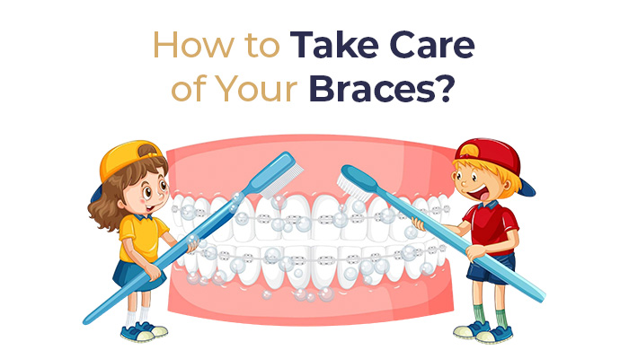 How to Take Care of Your Braces?